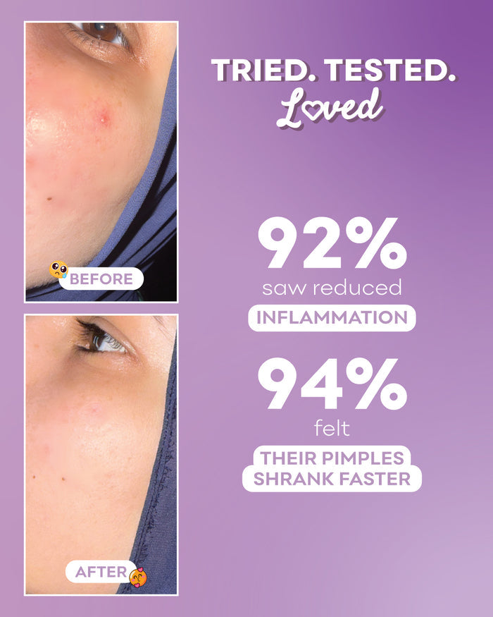 Advertisement showing before and after skin conditions with statistics on a purple background