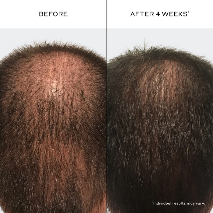 Before and after fuller-looking hair results using men’s thinning hair shampoo and conditioner system, visible improvement in hair density appearance after consistent use, individual results may vary.