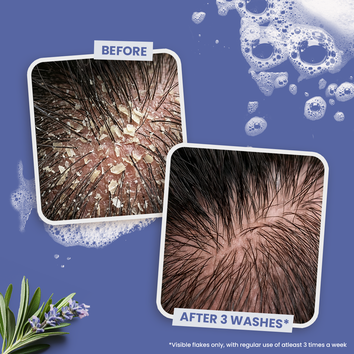 Sesa Anti-Dandruff Shampoo (ZPTO Free)